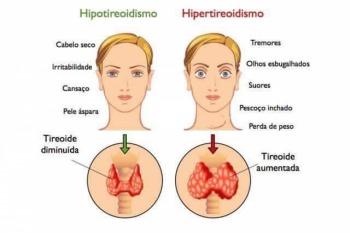 Diferen A De Hipotireoidismo E Hipertireoidismo